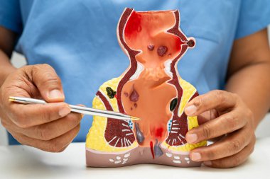 Hastanede rektum ve hemoroit insan anatomisi modeli olan Asyalı bir doktor vasküler yapısında iltihaplanma var..