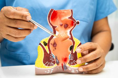 Hastanede rektum ve hemoroit insan anatomisi modeli olan Asyalı doktor..