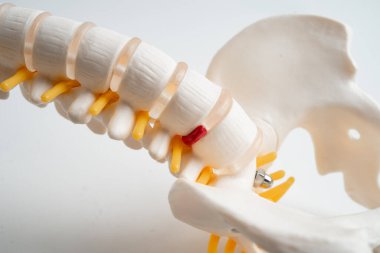 Bel omurgası yerinden oynamış disk parçası, omurilik ve kemik. Ortopedi bölümünde tedavi için model.