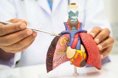 Zatürree, akciğer kanseri, Asyalı doktor hastanede teşhis ve tedavi için insan anatomisi modeli tutuyor.