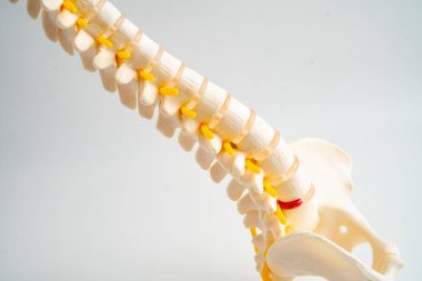 Bel omurgası yerinden oynamış disk parçası, omurilik ve kemik. Ortopedi bölümünde tedavi için model.