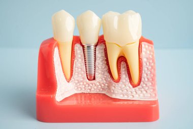 Diş implantı, çeneye yapay diş kökleri, diş tedavisinin kök kanalı, diş eti hastalığı, diş hekimliği üzerine çalışan dişçi modeli.