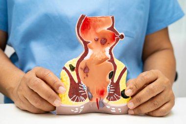 Hastanede rektum ve hemoroit insan anatomisi modeli olan Asyalı bir doktor vasküler yapısında iltihaplanma var..