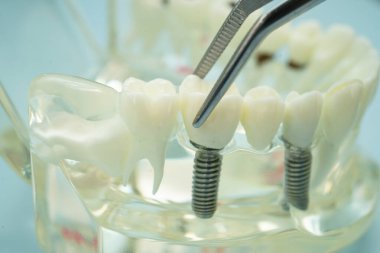 Diş hekimliği için dişçi aracı olan diş modeli.