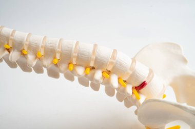 Bel omurgası yerinden oynamış disk parçası, omurilik ve kemik. Ortopedi bölümünde tedavi için model.