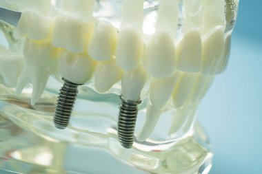 Diş implantı, çeneye yapay diş kökleri, diş tedavisinin kök kanalı, diş eti hastalığı, diş hekimliği üzerine çalışan dişçi modeli.