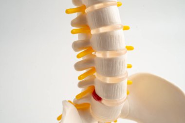 Bel omurgası yerinden oynamış disk parçası, omurilik ve kemik. Ortopedi bölümünde tedavi için model.