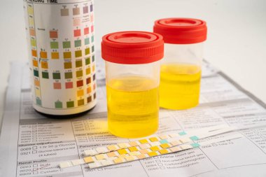 İdrar tahlili, reaksiyonlu idrar kabı. PH kağıt testi ve karşılaştırma tablosu laboratuvarda..