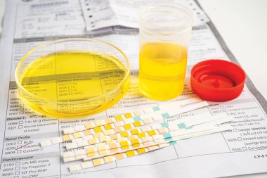 İdrar tahlili, reaksiyonlu idrar kabı. PH kağıt testi ve karşılaştırma tablosu laboratuvarda..