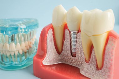 Diş implantı, çeneye yapay diş kökleri, diş tedavisinin kök kanalı, diş eti hastalığı, diş hekimliği üzerine çalışan dişçi modeli.