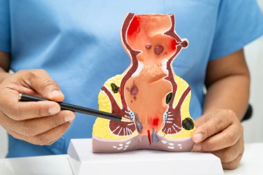 Hastanede rektum ve hemoroit insan anatomisi modeli olan Asyalı bir doktor vasküler yapısında iltihaplanma var..