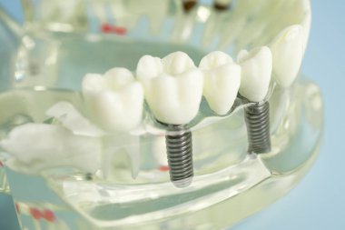 Diş implantı, çeneye yapay diş kökleri, diş tedavisinin kök kanalı, diş eti hastalığı, diş hekimliği üzerine çalışan dişçi modeli.