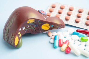 Hap tedavisi gören karaciğer modeli, siroz, karaciğer kanseri, yağlı karaciğer..