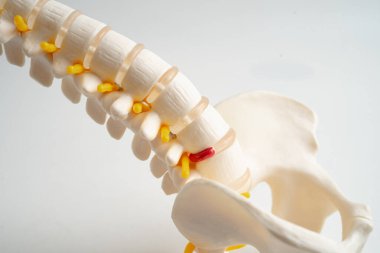 Bel omurgası yerinden oynamış disk parçası, omurilik ve kemik. Ortopedi bölümünde tedavi için model.