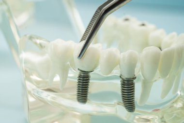 Diş hekimliği için dişçi aracı olan diş modeli.