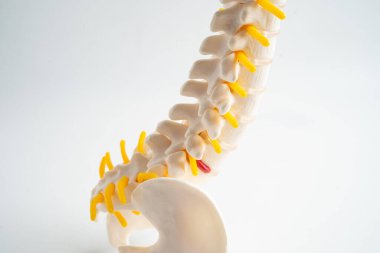 Bel omurgası yerinden oynamış disk parçası, omurilik ve kemik. Ortopedi bölümünde tedavi için model.