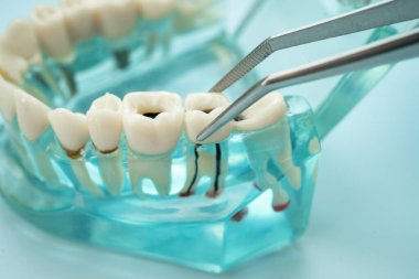 Diş hekimliği için dişçi aracı olan diş modeli.