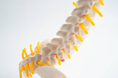 Bel omurgası yerinden oynamış disk parçası, omurilik ve kemik. Ortopedi bölümünde tedavi için model.