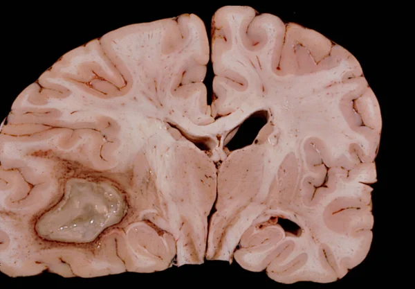 Coronal section through a human brain at the thalamus level showing a large abscess, probably of bacterial origin, located in the temporal lobe. The growth of the abscess produces a deviation of the lateral ventricle.