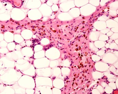 Peritoneal fat showing macrophages marked with colloidal iron. Colloidal iron can be used as a vital stain to mark macrophages. Circulating colloidal iron is phagocyted by macrophages appearing as large brown cytoplasmic inclusions