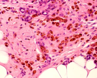 Peritoneal fat showing macrophages marked with colloidal iron. Colloidal iron can be used as a vital stain to mark macrophages. Circulating colloidal iron is phagocyted by macrophages appearing as large brown cytoplasmic inclusions