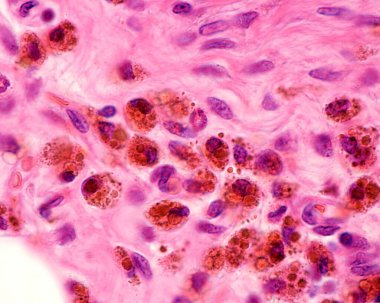 Macrophages heavily labelled with colloidal iron. Colloidal iron can be used as a vital stain to mark macrophages. Circulating colloidal iron is phagocyted by macrophages appearing as large brown cytoplasmic inclusions