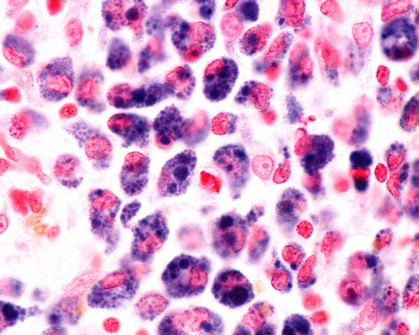 High magnification micrograph showing macrophages of an inflammation zone heavily marked with Trypan blue. Trypan blue is a vital stain that can be introduced in the body. Circulating Trypan blue is phagocyted by macrophages and concentrates on phago