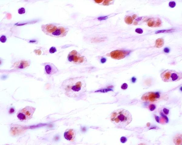 Macrophages showing large brown inclusions originated by phagocytosis of red blood cells after a haemorrhage