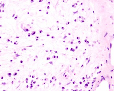 Plasma cells are B lymphocytes activated by the presence of antigens that secrete large quantities of antibodies. They appear in tissues affected by chronic inflammation. This micrograph shows plasma cells with eccentric nuclei and basophilic cytopla