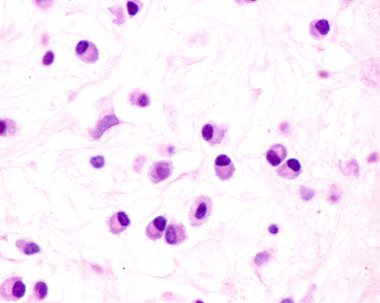 Plasma cells are B lymphocytes activated by the presence of antigens that secrete large quantities of antibodies. They appear in tissues affected by chronic inflammation. This micrograph shows plasma cells with eccentric nuclei and basophilic cytopla