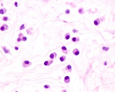 Plasma cells are B lymphocytes activated by the presence of antigens that secrete large quantities of antibodies. They appear in tissues affected by chronic inflammation. This micrograph shows plasma cells with eccentric nuclei and basophilic cytopla