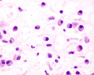 Plasma cells are B lymphocytes activated by the presence of antigens that secrete large quantities of antibodies. They appear in tissues affected by chronic inflammation. This micrograph shows plasma cells with eccentric nuclei and basophilic cytopla