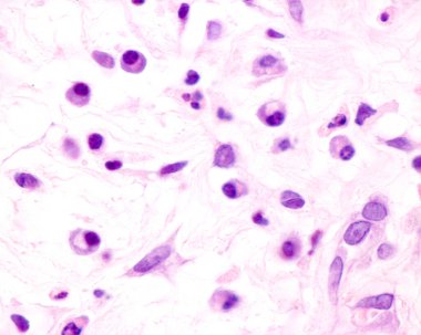 Plasma cells are B lymphocytes activated by the presence of antigens that secrete large quantities of antibodies. They appear in tissues affected by chronic inflammation. This micrograph shows plasma cells with eccentric nuclei and basophilic cytopla