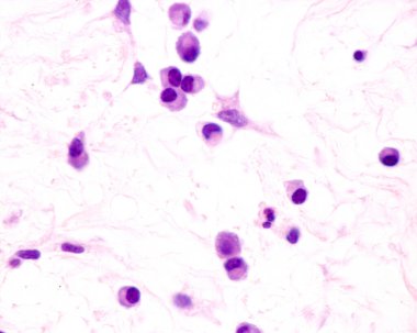 Plasma cells are B lymphocytes activated by the presence of antigens that secrete large quantities of antibodies. They appear in tissues affected by chronic inflammation. This micrograph shows plasma cells with eccentric nuclei and basophilic cytopla