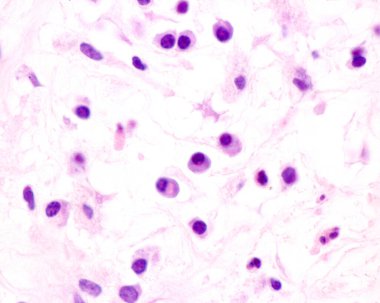 Plasma cells are B lymphocytes activated by the presence of antigens that secrete large quantities of antibodies. They appear in tissues affected by chronic inflammation. This micrograph shows plasma cells with eccentric nuclei and basophilic cytopla
