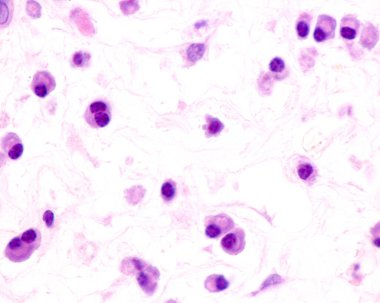 Plasma cells are B lymphocytes activated by the presence of antigens that secrete large quantities of antibodies. They appear in tissues affected by chronic inflammation. This micrograph shows plasma cells with eccentric nuclei and basophilic cytopla