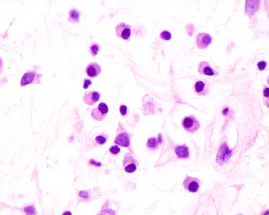 Plasma cells are B lymphocytes activated by the presence of antigens that secrete large quantities of antibodies. They appear in tissues affected by chronic inflammation. This micrograph shows plasma cells with eccentric nuclei and basophilic cytopla