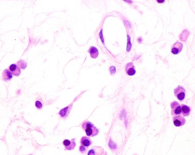 Plasma cells are B lymphocytes activated by the presence of antigens that secrete large quantities of antibodies. They appear in tissues affected by chronic inflammation. This micrograph shows plasma cells with eccentric nuclei and basophilic cytopla