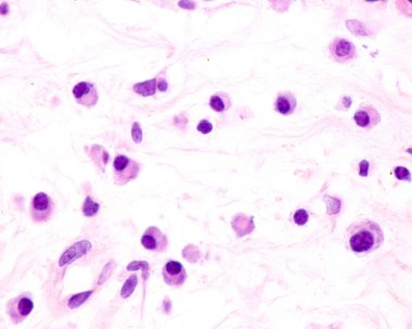 Plasma cells are B lymphocytes activated by the presence of antigens that secrete large quantities of antibodies. They appear in tissues affected by chronic inflammation. This micrograph shows plasma cells with eccentric nuclei and basophilic cytopla