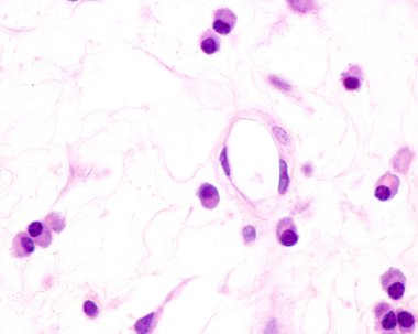 Plasma cells are B lymphocytes activated by the presence of antigens that secrete large quantities of antibodies. They appear in tissues affected by chronic inflammation. This micrograph shows plasma cells with eccentric nuclei and basophilic cytopla