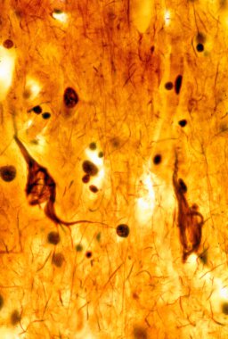 Light micrograph of a human cerebral cortex showing neurofibrillary tangles in two pyramidal neurons. Neurofibrillary tangles (NFTs) are a characteristic neuropathological lesion of Alzheimer's disease (AD). They are composed of a highly-phosphorylat
