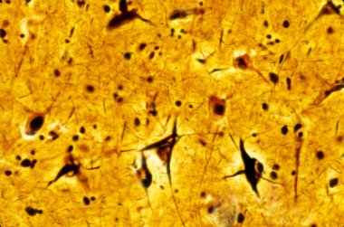 Light micrograph of a human cerebral cortex showing neurofibrillary tangles in several pyramidal neurons. Neurofibrillary tangles (NFTs) are a characteristic neuropathological lesion of Alzheimer's disease (AD). They are composed of a highly-phosphor