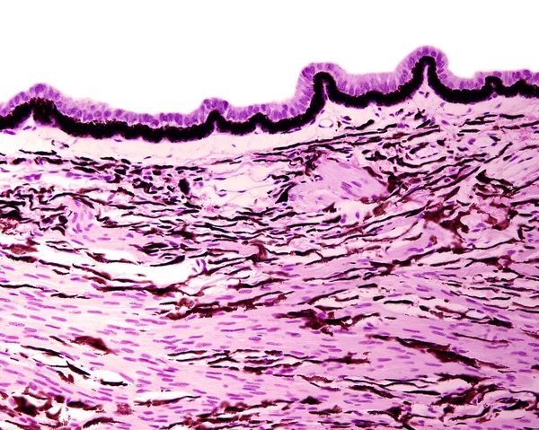 Human ciliary body. From bottom:ciliary body stroma showing blood vessels, pigmented cells full of melanin granules, and many fascicles of smooth muscle fibers belonging to ciliary muscle. On bottom, several ciliary processes are lined by a double ep