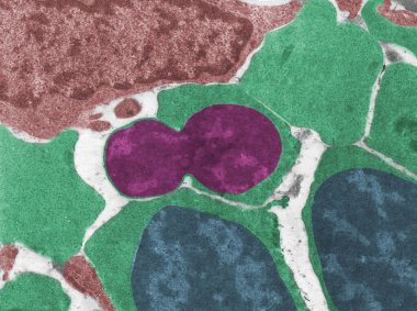 Coloured transmission electron micrograph (TEM) of normoblasts, a nucleated (blue) red blood cell precursor in the process of expulsion or extrusion of the nucleus (magenta). When this process ends, the cell that remains is an anucleated reticulocyte clipart
