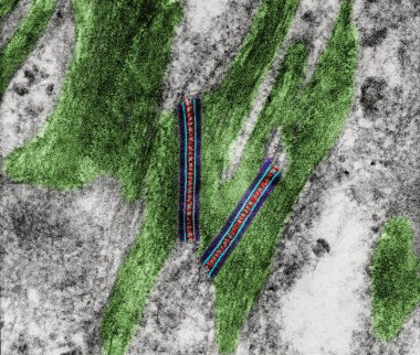Coloured transmission electron micrograph (TEM) showing two desmosomes (maculae adherens) with prominent cadherin dense plaques (blue) where keratin intermediate filaments (ligh green) were attached. The intercellular space show dark bridges (red) of clipart