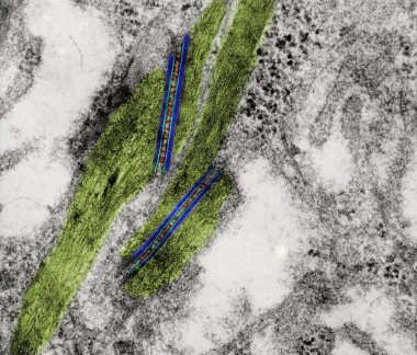 Coloured transmission electron micrograph (TEM) showing two desmosomes (maculae adherens) with prominent cadherin dense plaques (blue) where keratin intermediate filaments (light green) were attached. The intercellular space shows dark bridges (red)  clipart