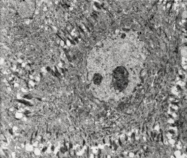 Epidermis. Electron microscope micrograph showing a keratinocyte of spinous layer. The epithelial cell has a polygonal shape, central nucleus with nucleolus, cytoplasm full of keratin filament bundles, and numerous dark desmosomes crossing the interc clipart