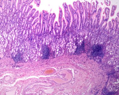 Pyloric antrum bölgesindeki mide mukozası tipik özelliklerini gösteriyor: büyük gastrik mahzenlerin derinliği ve pilorik bezlerin varlığı. Lazer pervanesinde kronik iltihaplı infiltreler ve lenfoid foliküller var.