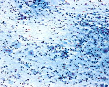 Vaginal smear stained with Papanicolau method. The visible cells are all normal squamous superficial cells with polygonal shape, pyknotic nuclei and bluish or redish cytoplasm, and some parabasal cells. The abundance of neutrophil leukocytes suggests clipart