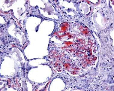 Amiloidoz, Kongo kırmızı lekesi ile kanıtlanabilen amiloit tortusu denen proteinlerin kümelenmesine yol açan normal çözünür proteinlerin anormal şekilde katlanmasından kaynaklanır. Amiloit lekeli bir böbrekte hafif bir amiloidoz mikrografı var.